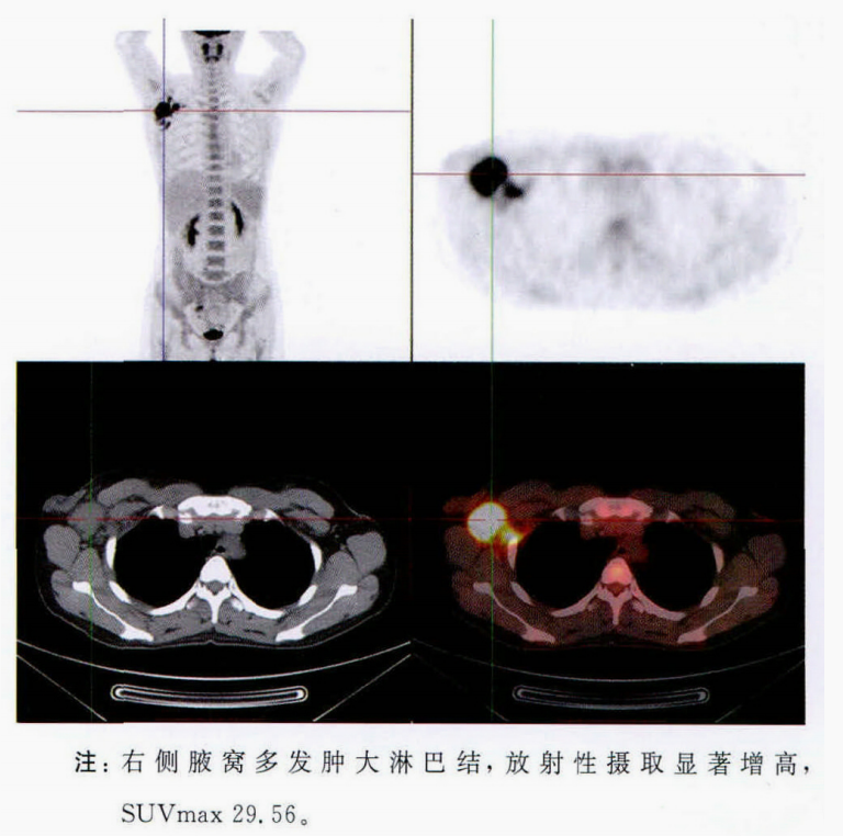 影像PPT - 猫抓病性淋巴结炎-5 影像PPT - 猫抓病性淋巴结炎-5