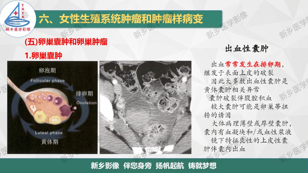 影像PPT - 【PPT】卵巢肿瘤的影像表现-9