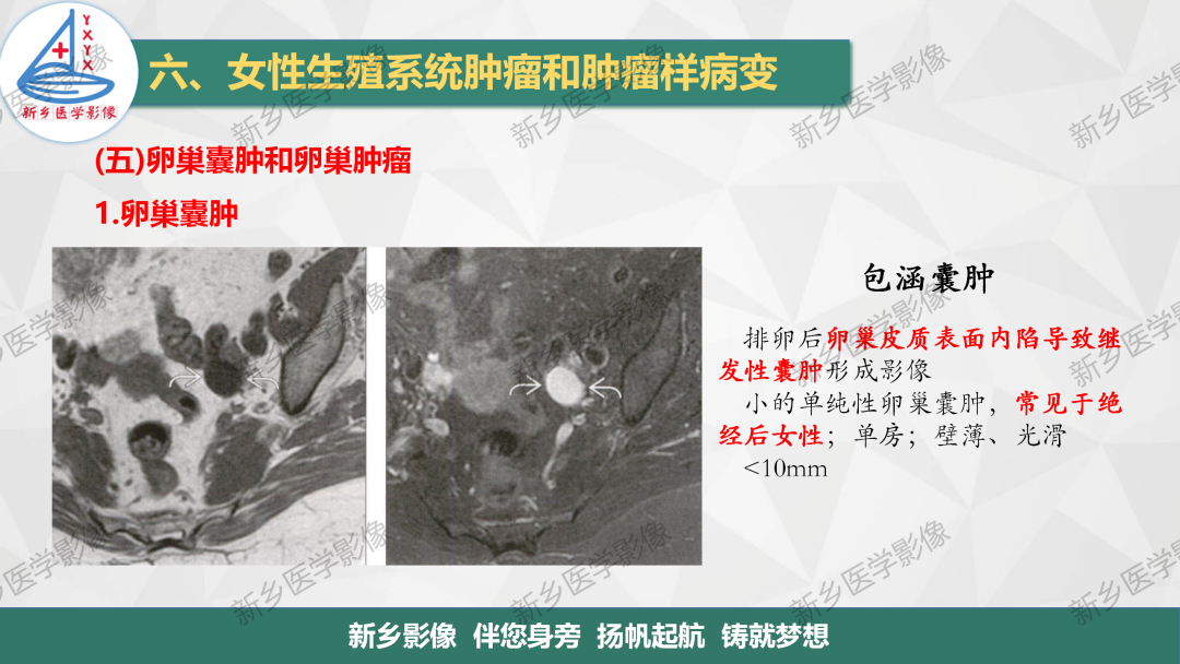 影像PPT - 【PPT】卵巢肿瘤的影像表现-8