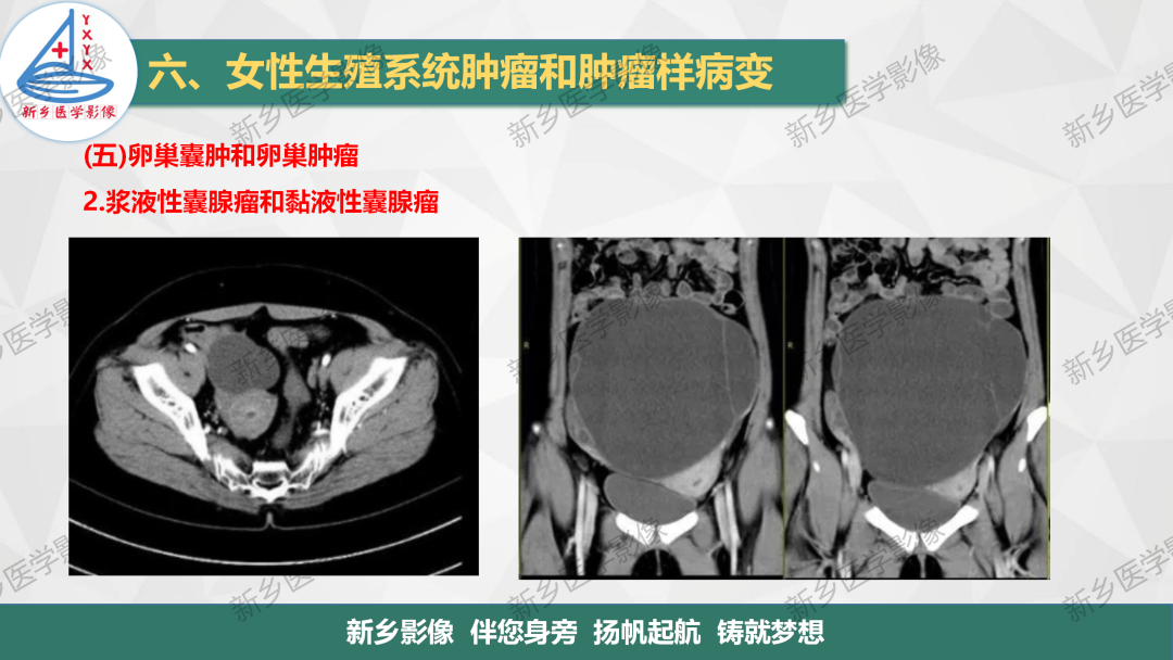 影像PPT - 【PPT】卵巢肿瘤的影像表现-12