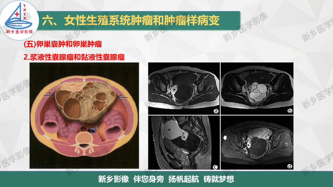 影像PPT - 【PPT】卵巢肿瘤的影像表现-13