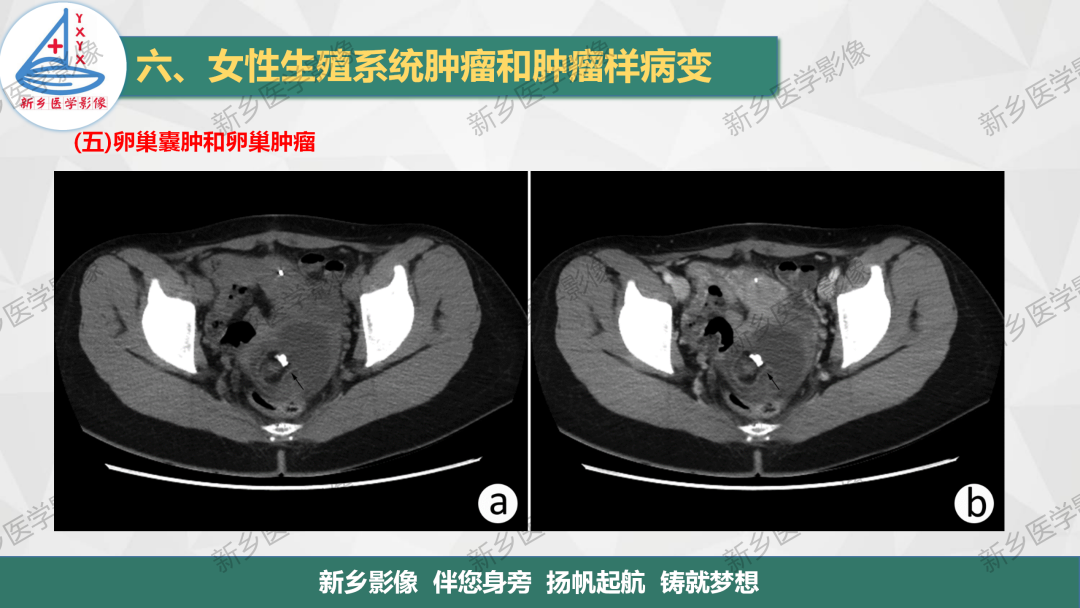 影像PPT - 【PPT】卵巢肿瘤的影像表现-16