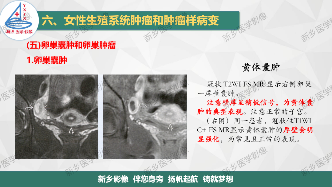 影像PPT - 【PPT】卵巢肿瘤的影像表现-6