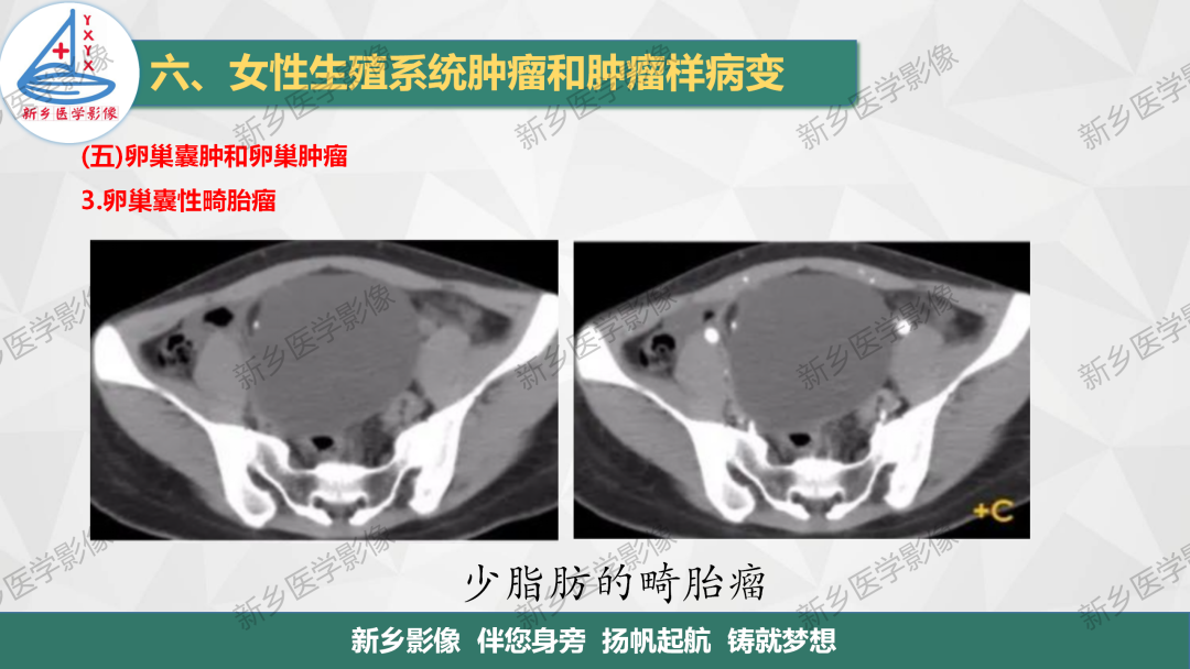 影像PPT - 【PPT】卵巢肿瘤的影像表现-18