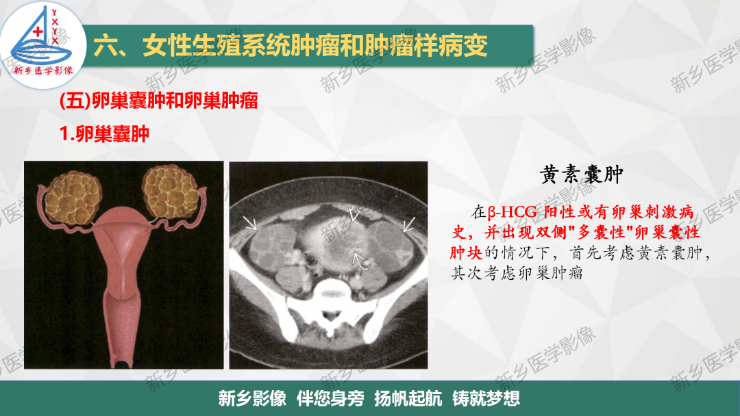影像PPT - 【PPT】卵巢肿瘤的影像表现-7