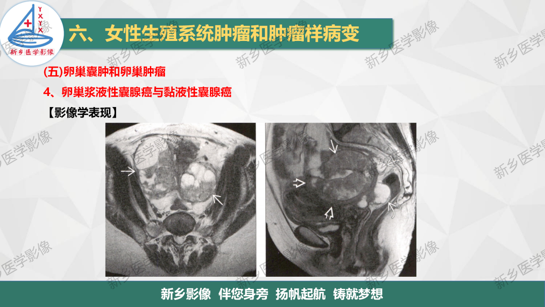 影像PPT - 【PPT】卵巢肿瘤的影像表现-24