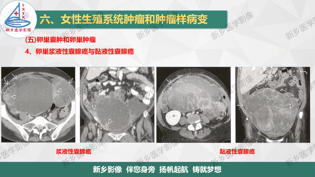 影像PPT - 【PPT】卵巢肿瘤的影像表现-22