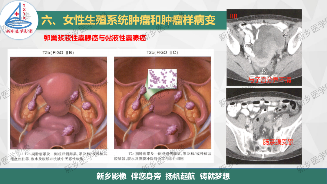 影像PPT - 【PPT】卵巢肿瘤的影像表现-30