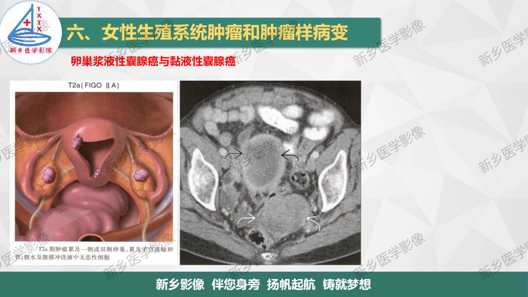 影像PPT - 【PPT】卵巢肿瘤的影像表现-29