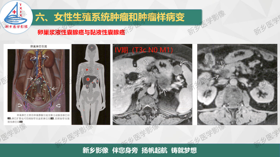影像PPT - 【PPT】卵巢肿瘤的影像表现-33