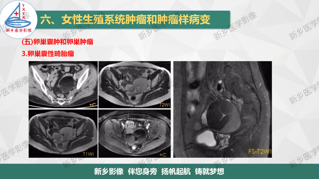 影像PPT - 【PPT】卵巢肿瘤的影像表现-17