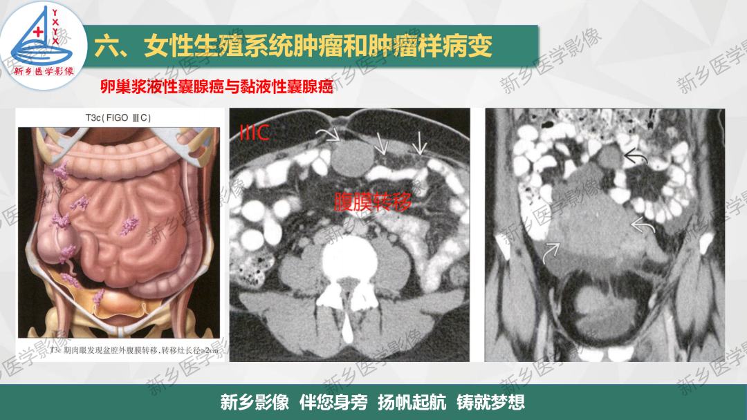 影像PPT - 【PPT】卵巢肿瘤的影像表现-32