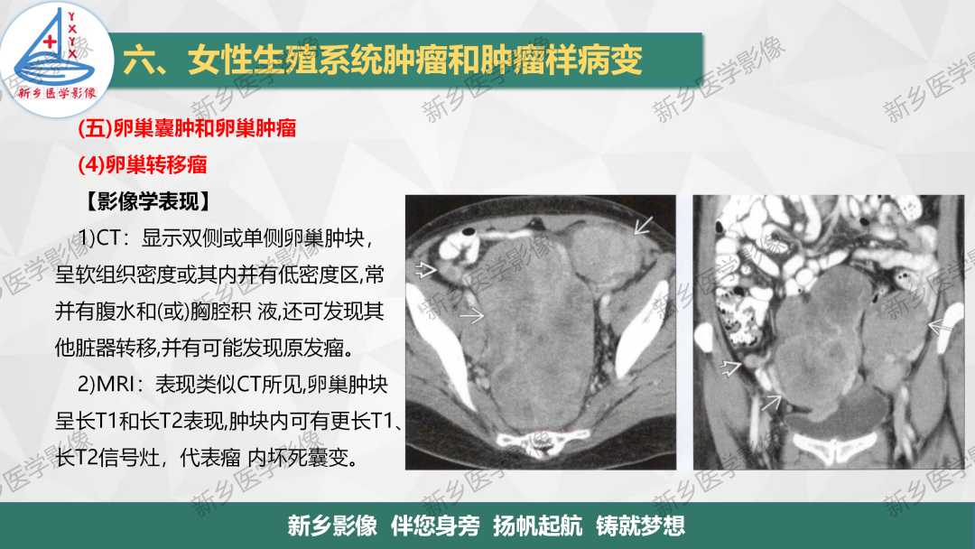 影像PPT - 【PPT】卵巢肿瘤的影像表现-35