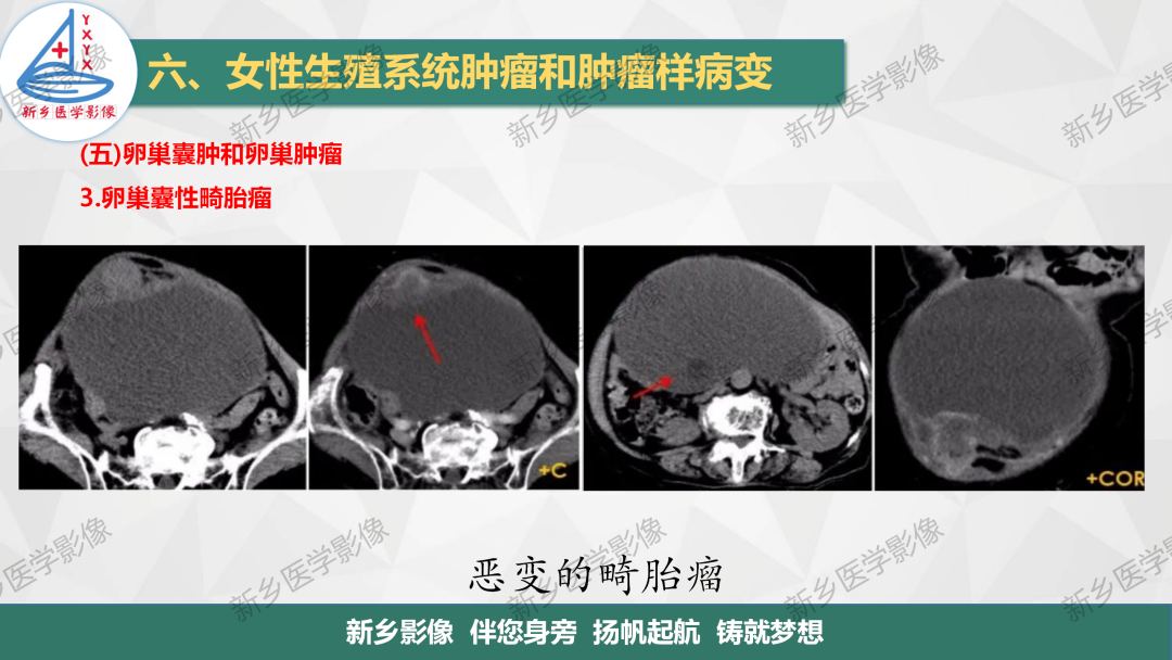 影像PPT - 【PPT】卵巢肿瘤的影像表现-19
