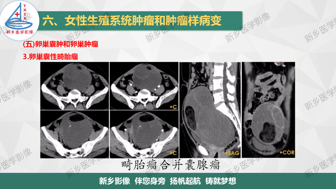 影像PPT - 【PPT】卵巢肿瘤的影像表现-20