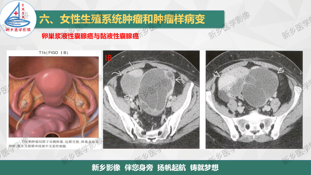 影像PPT - 【PPT】卵巢肿瘤的影像表现-27