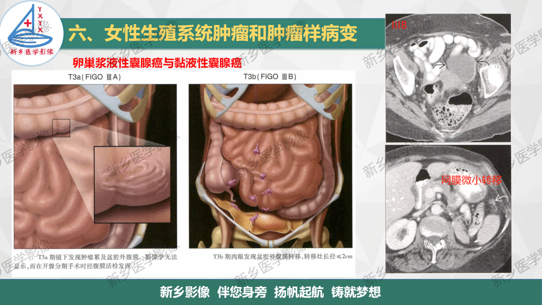 影像PPT - 【PPT】卵巢肿瘤的影像表现-31