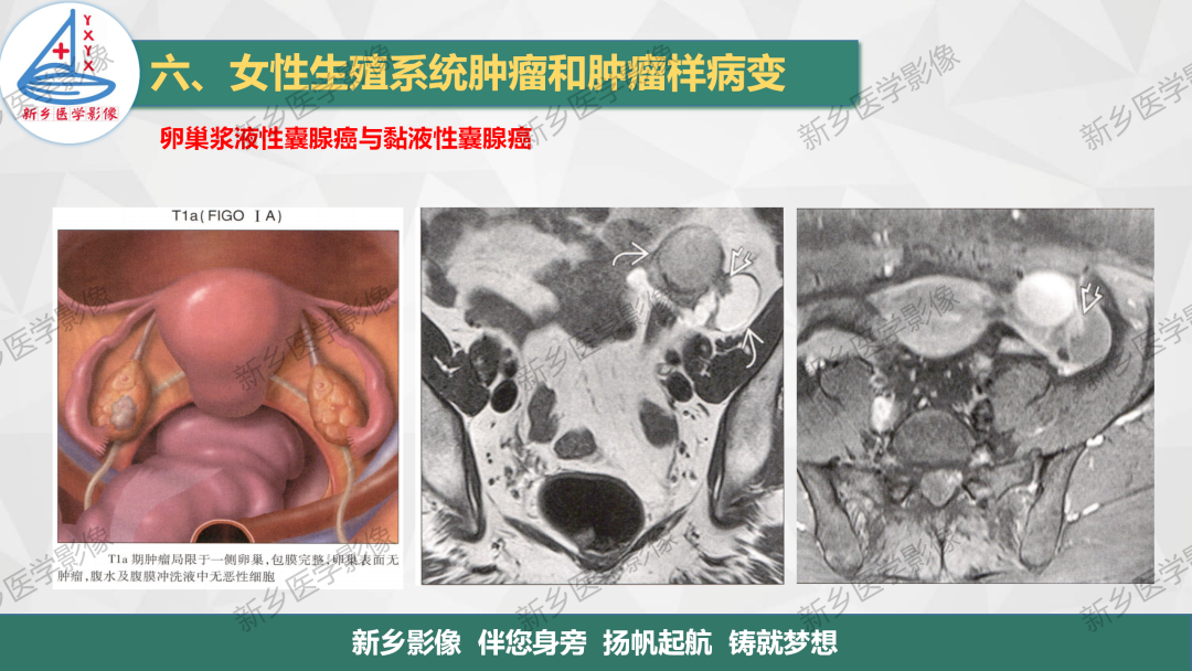 影像PPT - 【PPT】卵巢肿瘤的影像表现-26