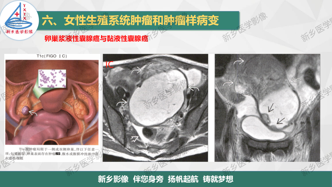 影像PPT - 【PPT】卵巢肿瘤的影像表现-28