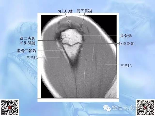 影像PPT - 【PPT】肩关节解剖-34