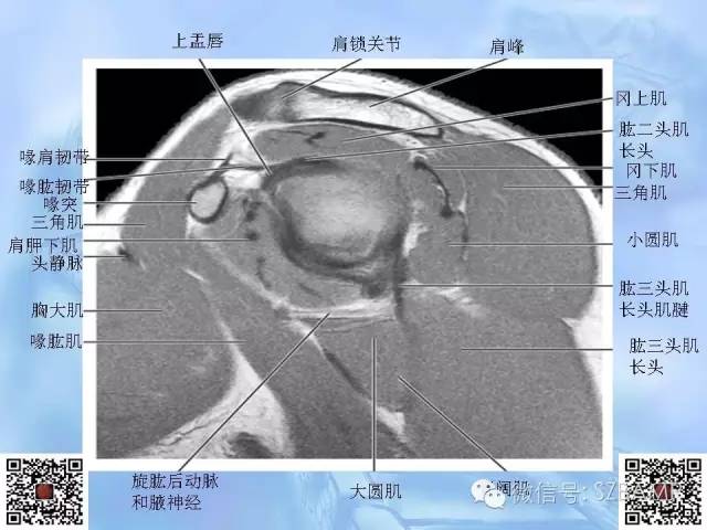 影像PPT - 【PPT】肩关节解剖-42