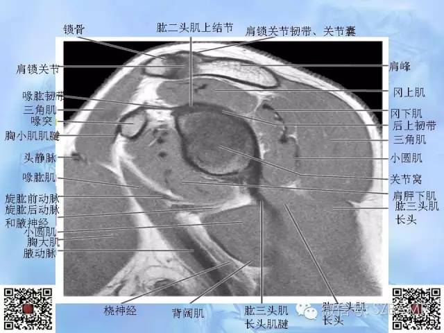 影像PPT - 【PPT】肩关节解剖-43
