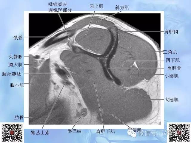 影像PPT - 【PPT】肩关节解剖-49