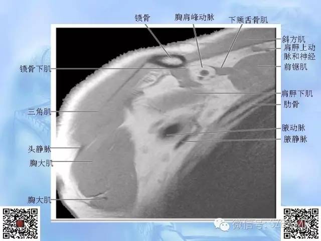 影像PPT - 【PPT】肩关节解剖-52