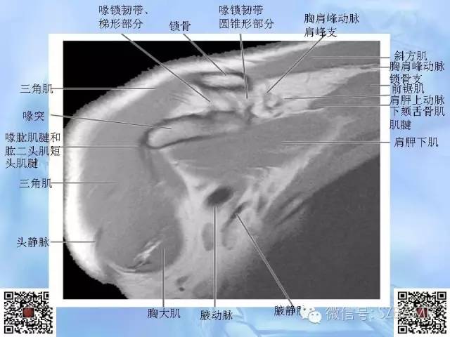 影像PPT - 【PPT】肩关节解剖-54