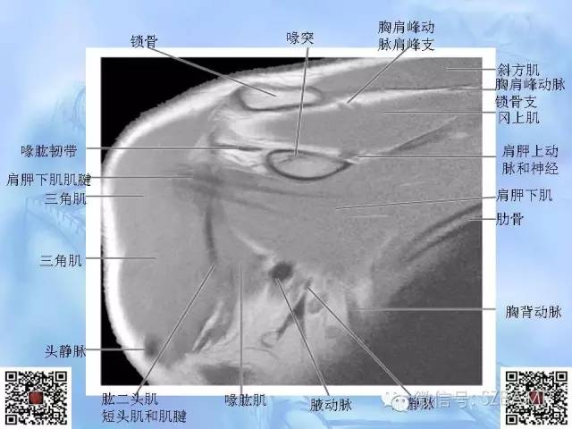 影像PPT - 【PPT】肩关节解剖-56