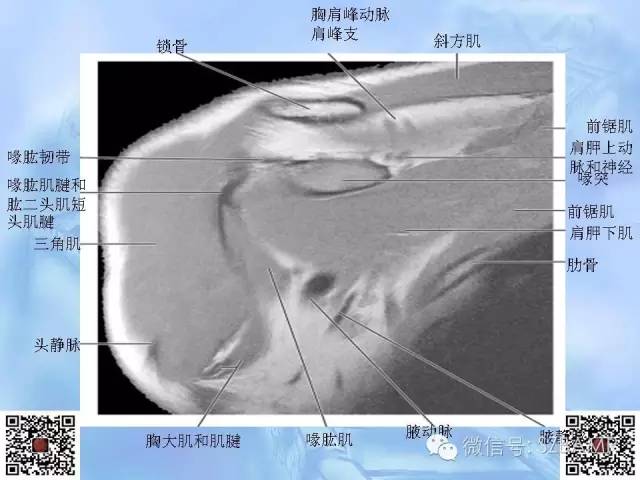 影像PPT - 【PPT】肩关节解剖-55