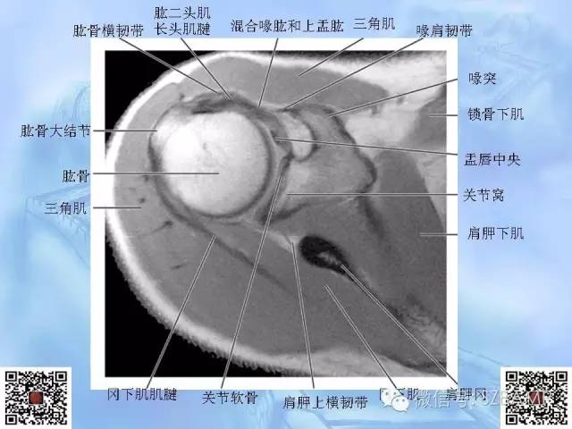 影像PPT - 【PPT】肩关节解剖-20
