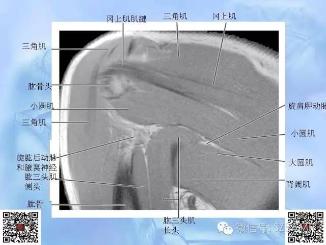 影像PPT - 【PPT】肩关节解剖-67