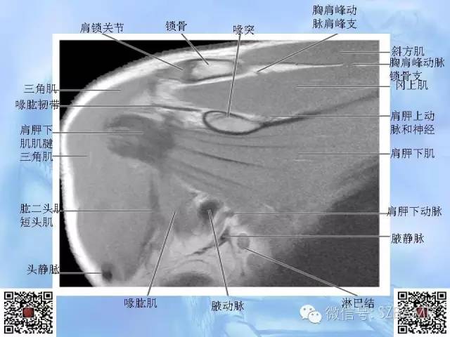 影像PPT - 【PPT】肩关节解剖-57