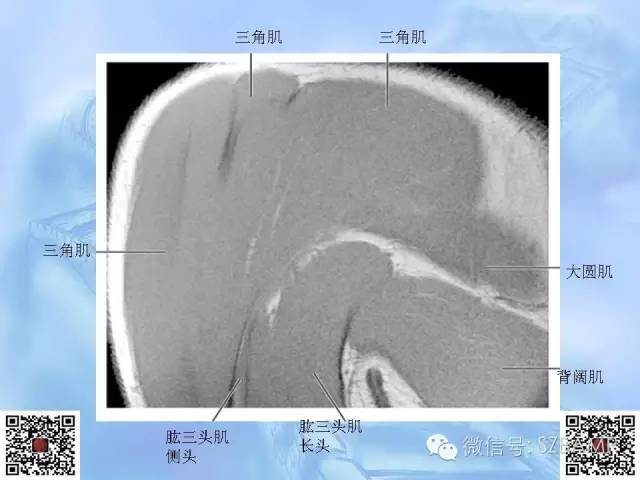 影像PPT - 【PPT】肩关节解剖-69