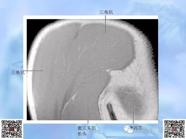 影像PPT - 【PPT】肩关节解剖-71