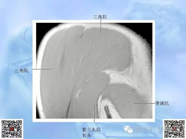 影像PPT - 【PPT】肩关节解剖-70