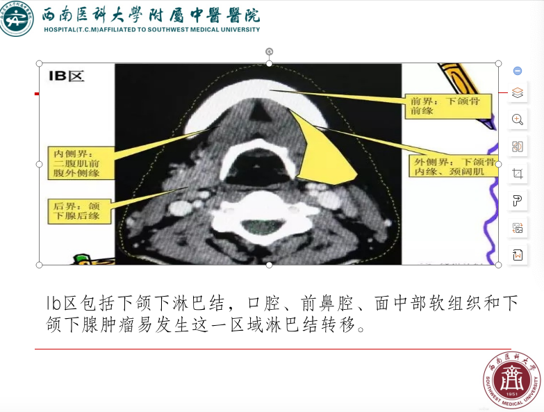 影像PPT - 【PPT】颈部淋巴结分区-11