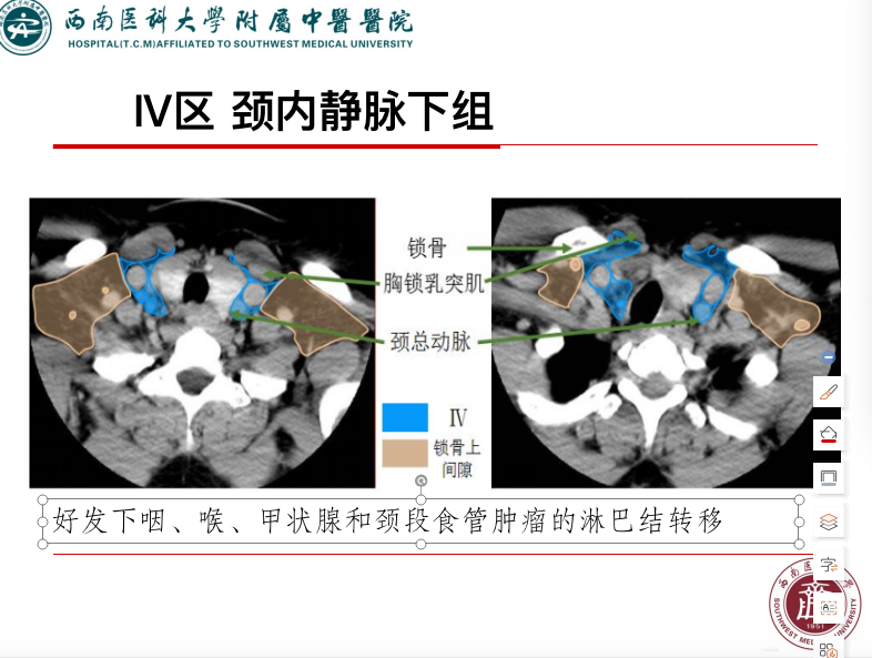 影像PPT - 【PPT】颈部淋巴结分区-20
