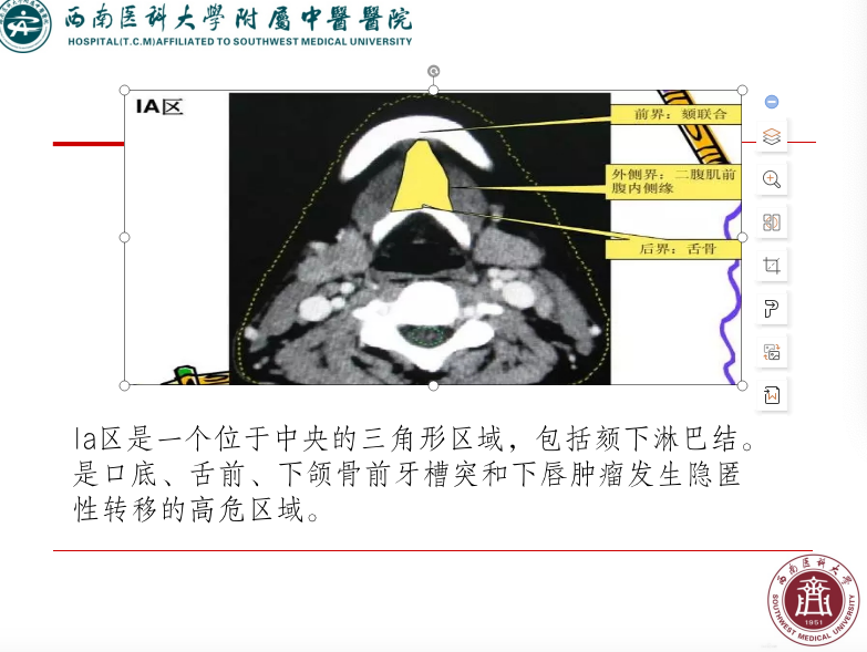 影像PPT - 【PPT】颈部淋巴结分区-10