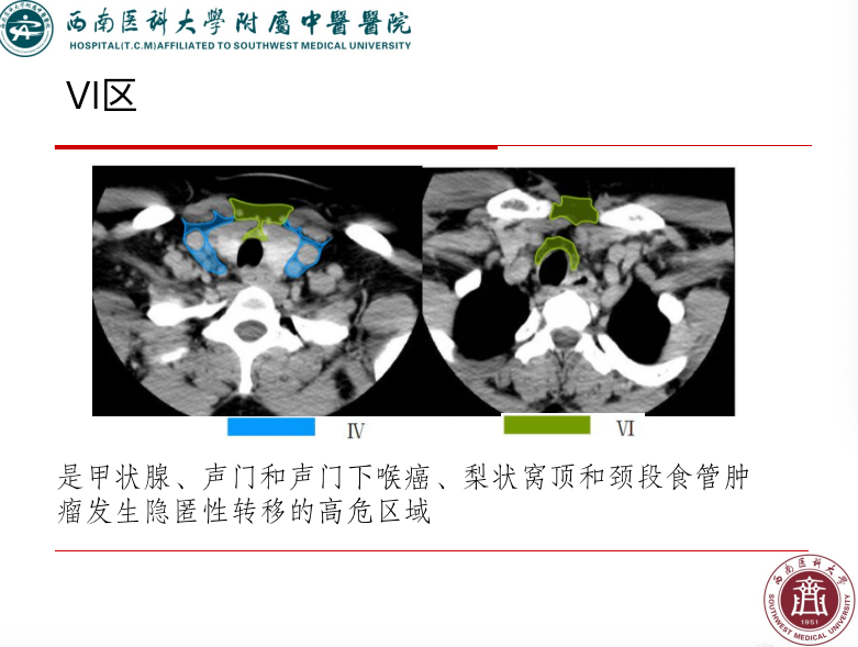 影像PPT - 【PPT】颈部淋巴结分区-28