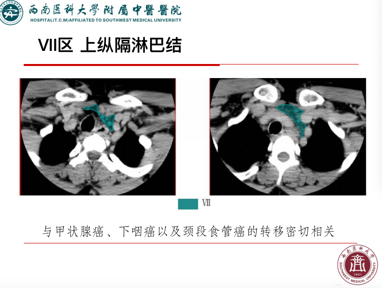 影像PPT - 【PPT】颈部淋巴结分区-30