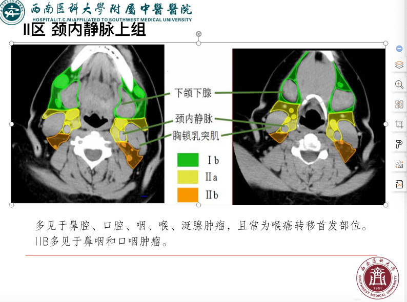 影像PPT - 【PPT】颈部淋巴结分区-14