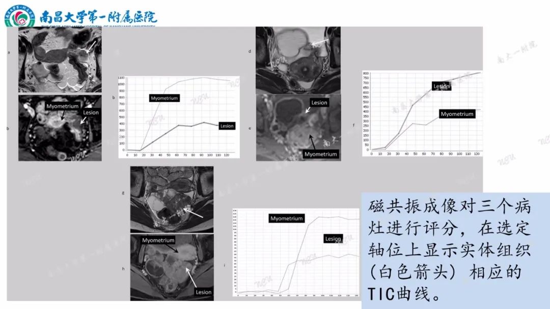 影像PPT - 【PPT】卵巢-附件病变O-RADS MRI评分-23