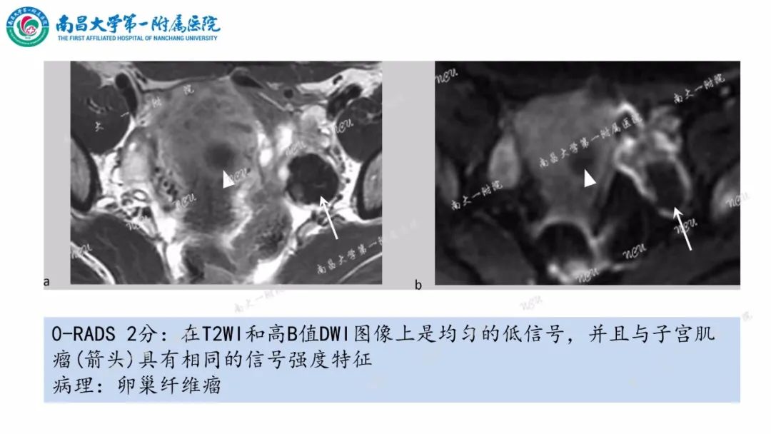 影像PPT - 【PPT】卵巢-附件病变O-RADS MRI评分-15