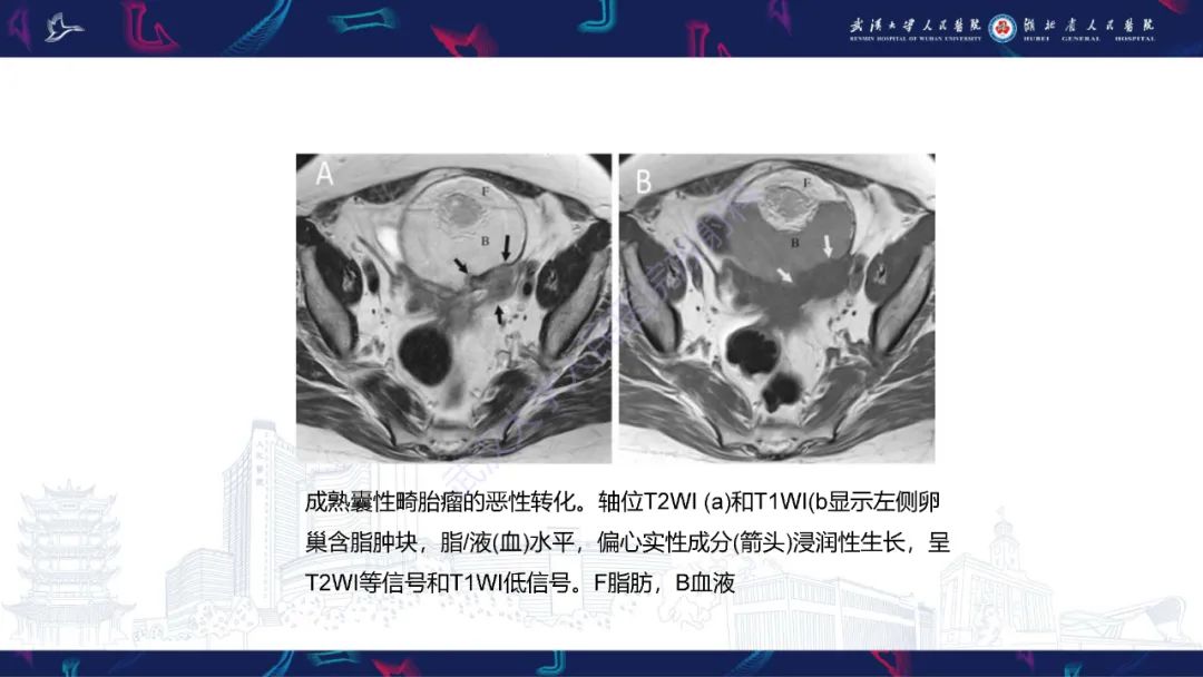 影像PPT - 【PPT】女性盆腔含脂肪病变影像诊断-6