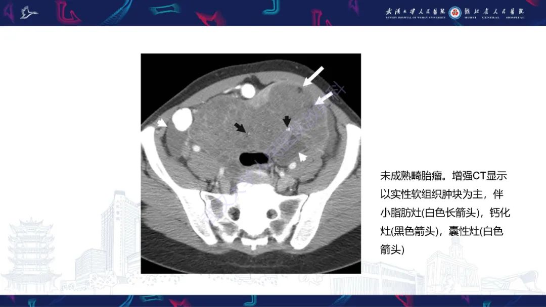 影像PPT - 【PPT】女性盆腔含脂肪病变影像诊断-9