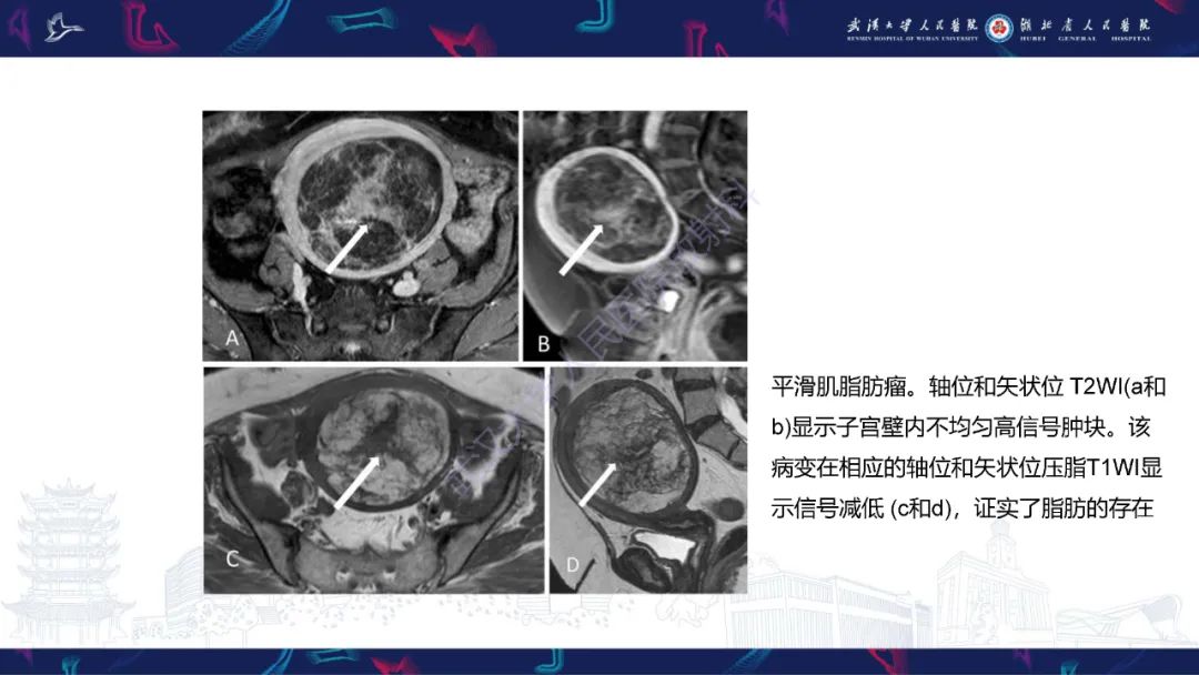 影像PPT - 【PPT】女性盆腔含脂肪病变影像诊断-17