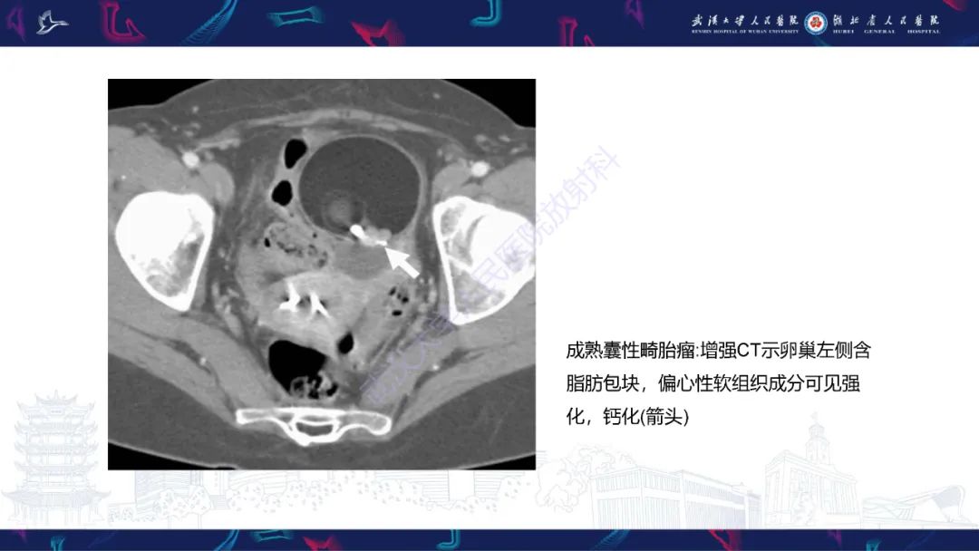 影像PPT - 【PPT】女性盆腔含脂肪病变影像诊断-4