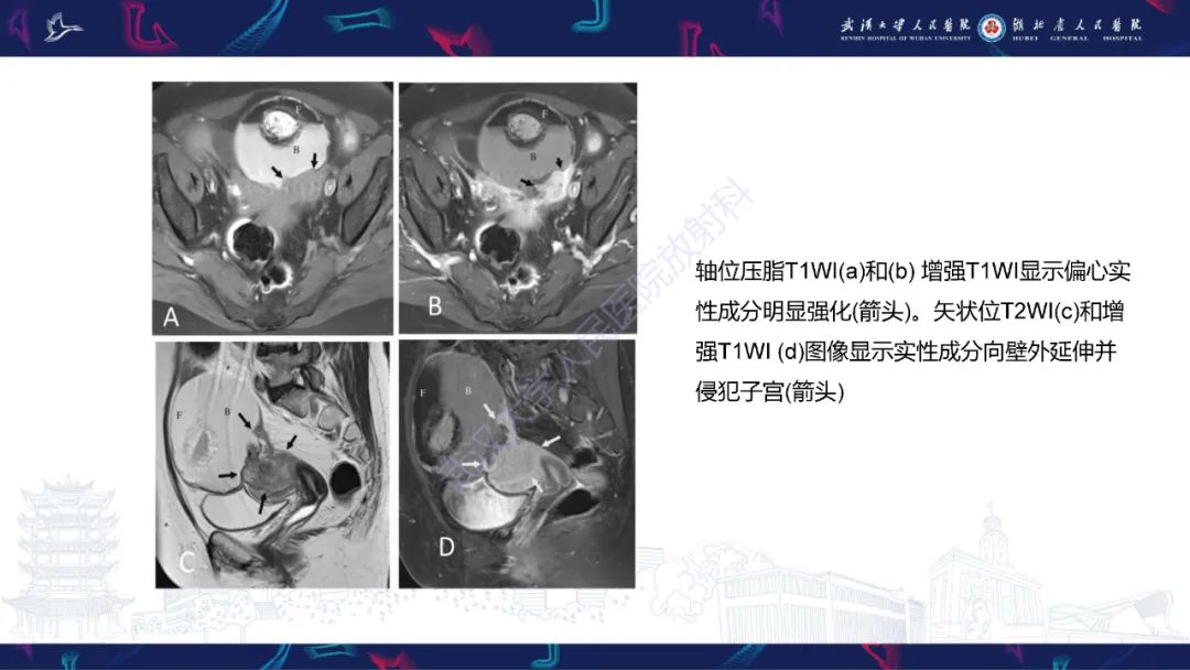 影像PPT - 【PPT】女性盆腔含脂肪病变影像诊断-7